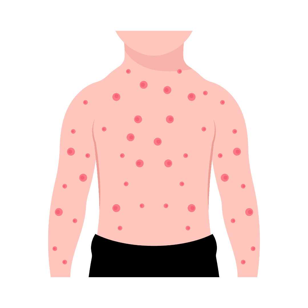 Chickenpox (varicella)