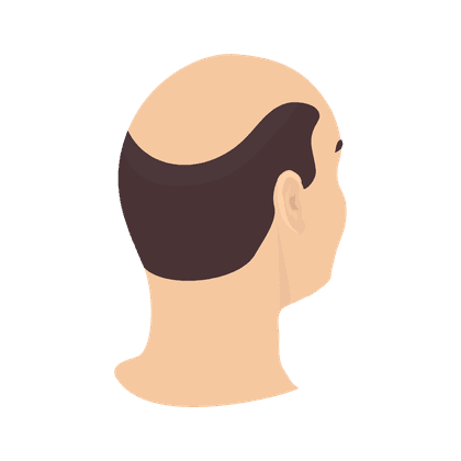 Alopecia (baldness, hair loss)